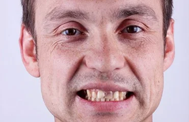 Виниры из диоксида циркония